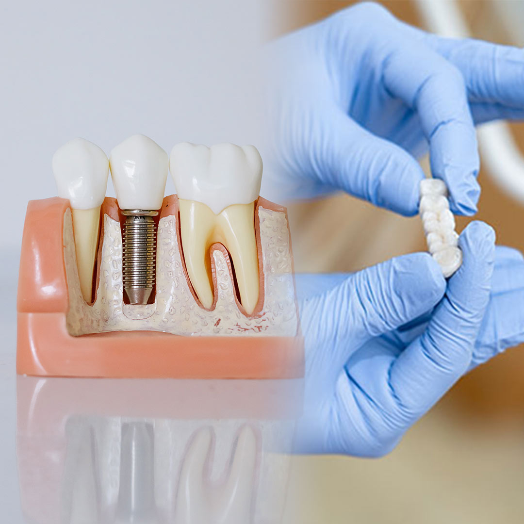 Implante o puente dental cuál es mejor y más adecuado para ti